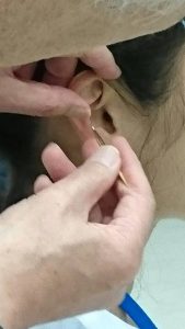 米軍でも兵士の治療に導入された耳鍼
